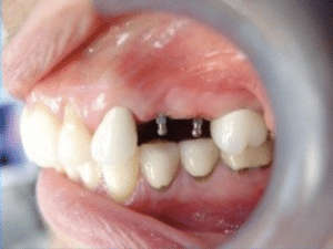 Mini Dental Implants Mini Dental Implants