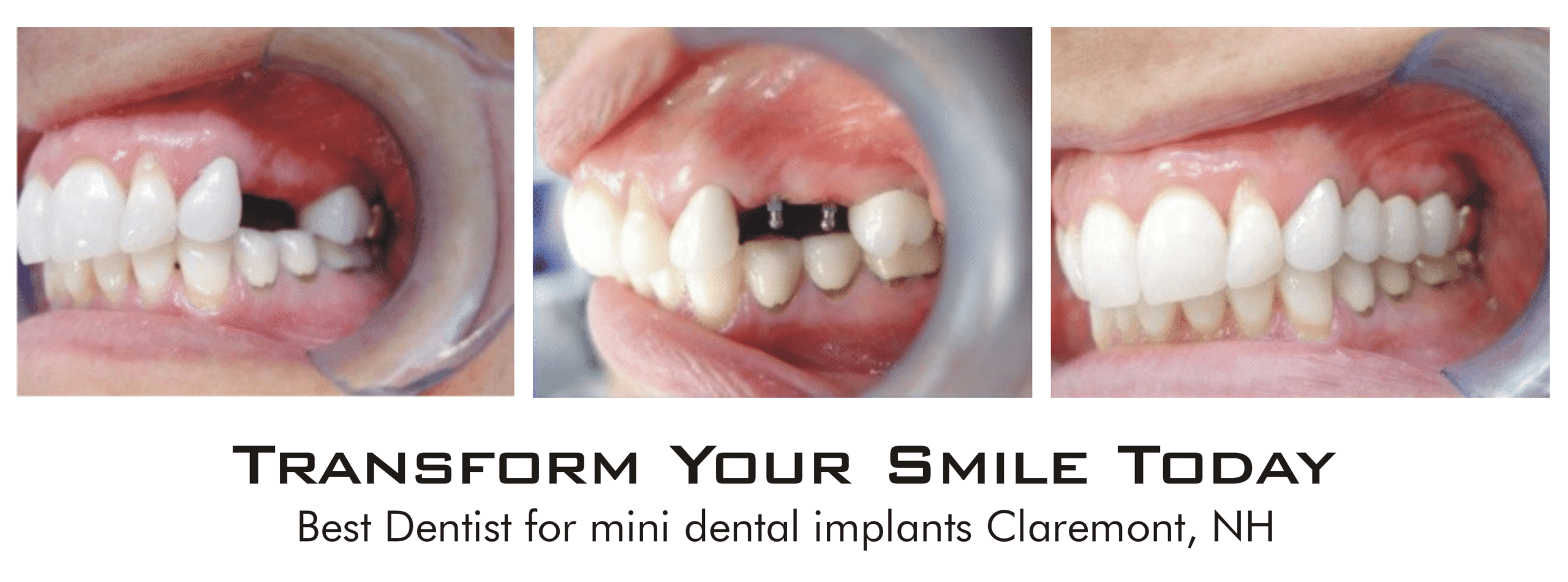 Mini Dent Implants